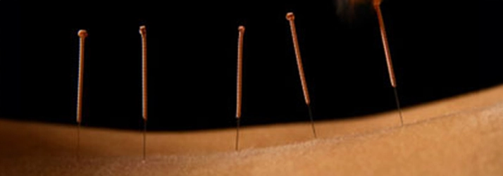 Chiropractic Baltimore MD Dry Needling On Back